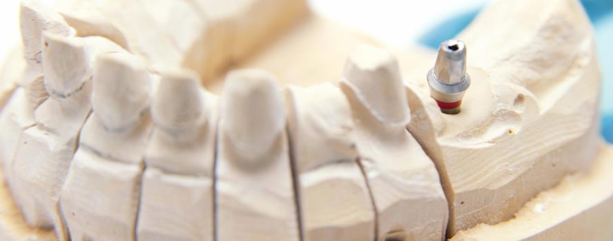 Dental Implants in Fort McMurray