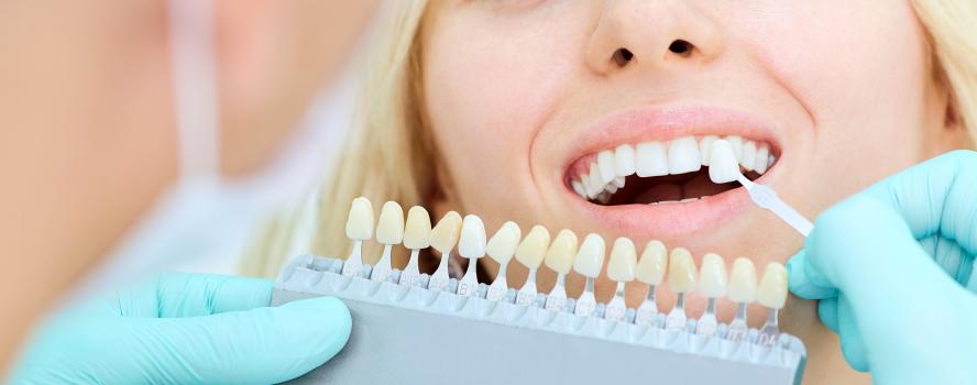 Teeth Whitening in Fort McMurray